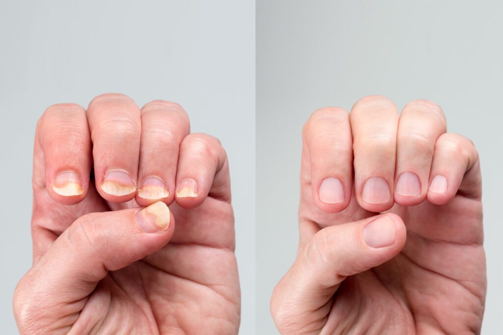 One Cup of This Will Destroy Your Nail Fungus (Ultimate Guide)